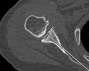 Glenoid Pre Rev TSR Axial CT